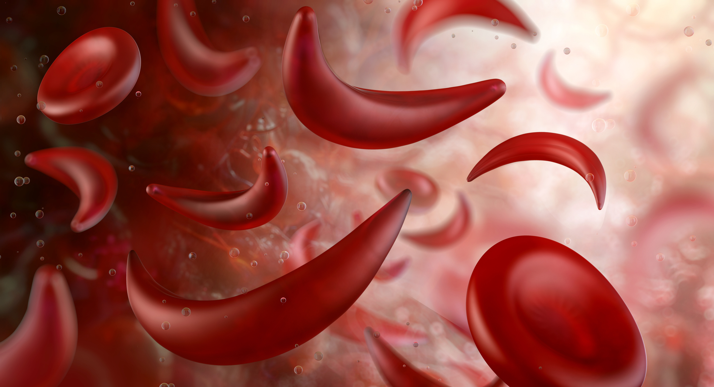Sickle cell anemia deformed red blood cells Sickle cell anemia deformed red blood cells