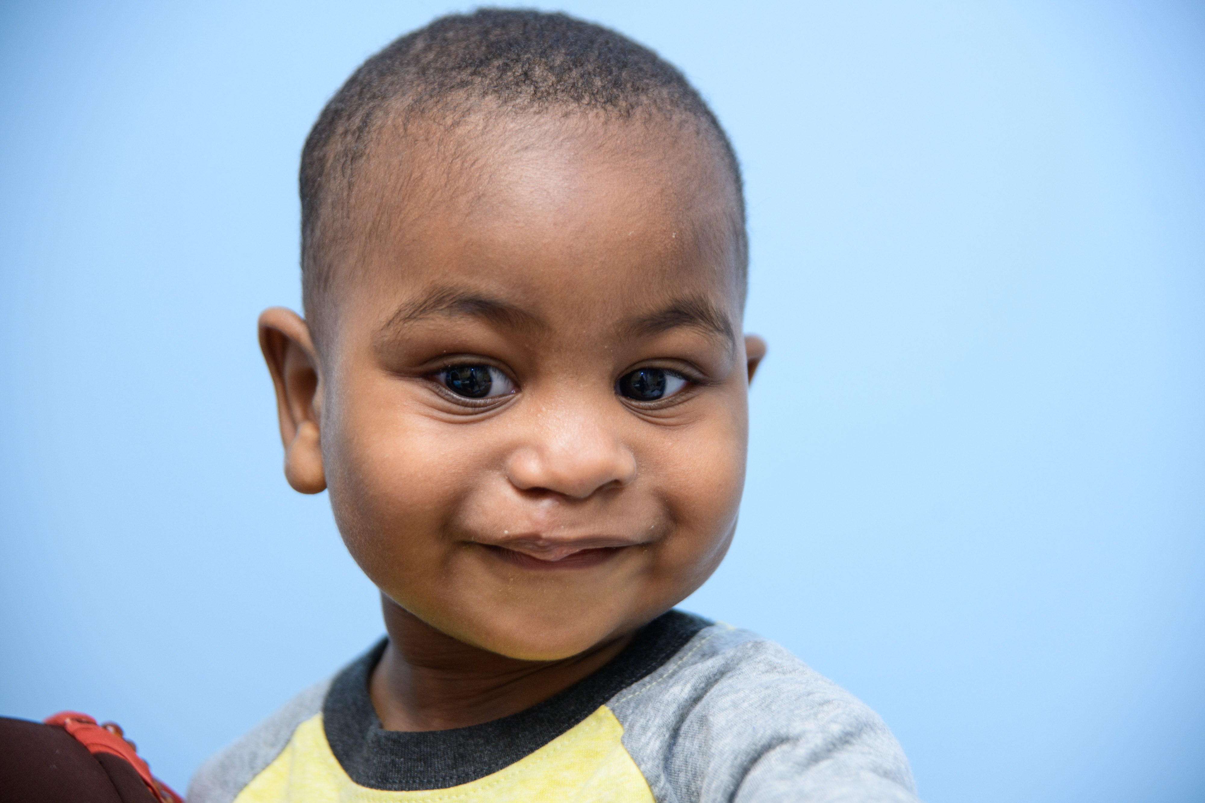 patient with cleft lip palate after surgery