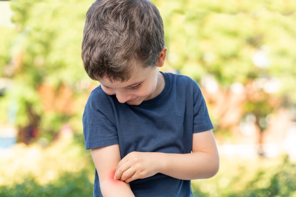 Young boy itching mosquito bite on arm. 