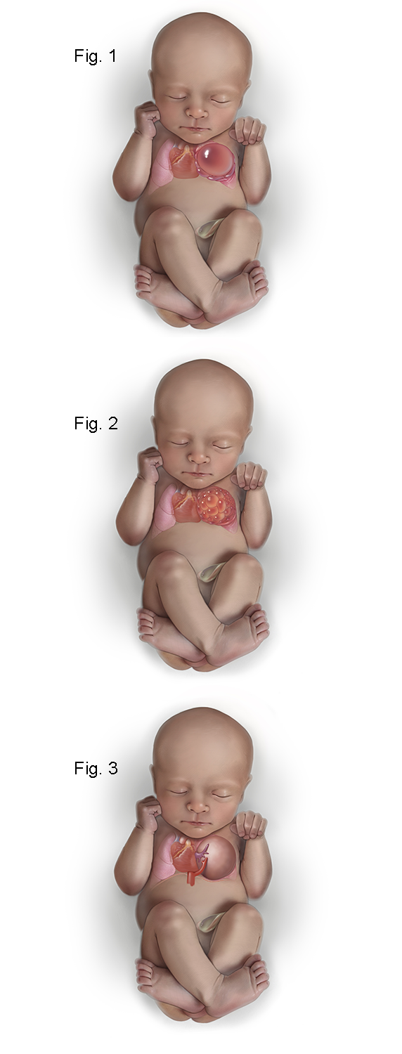 Medical Illustration of CPAM Type I, III and III