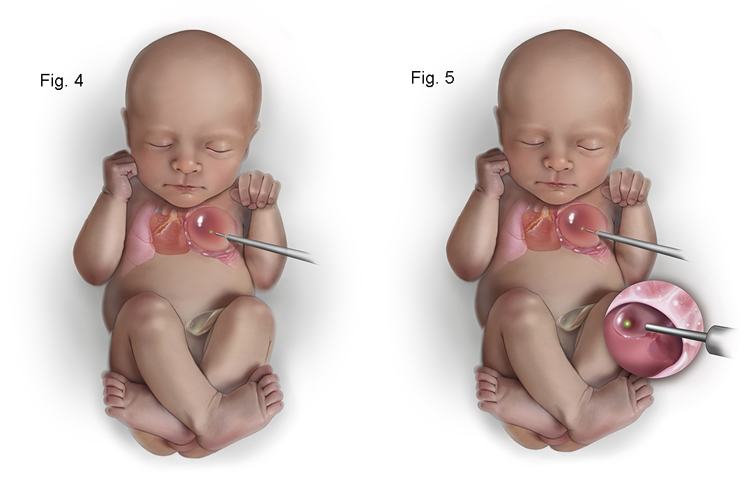 Medical illustration of CPAM