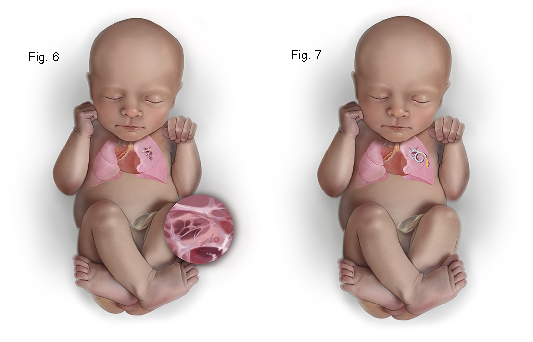 Medical Illustration of CPAM