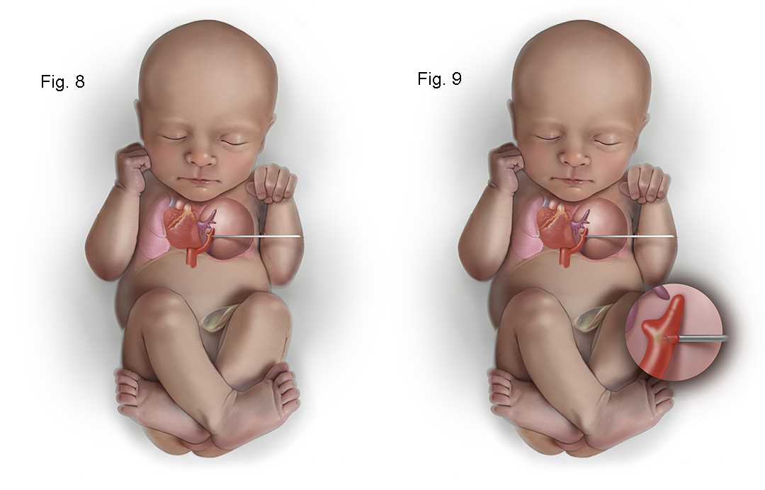 Medical Illustration of CPAM