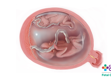 Medical Illustration of Twin-Twin Transfusion Syndrome