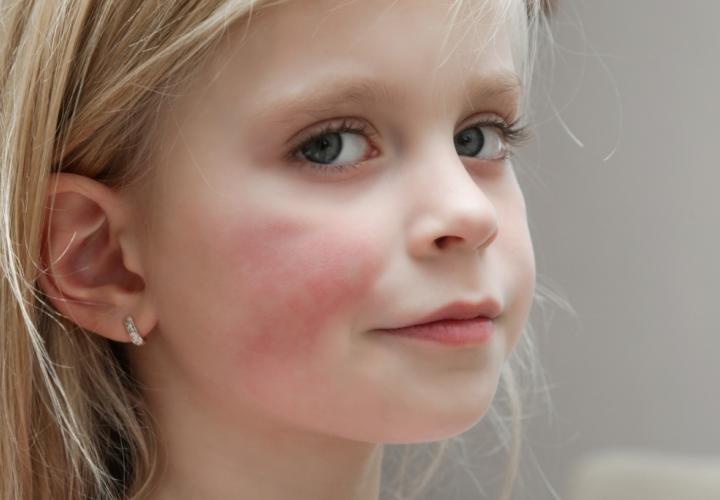 Young girl with red rash on right cheek