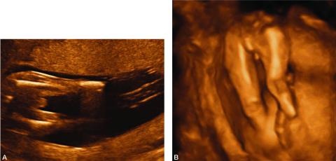 Amniotic Band Sequence, Fetal Care Center