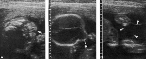 Amniotic Band Syndrome, Fetal Care and Treatment Center