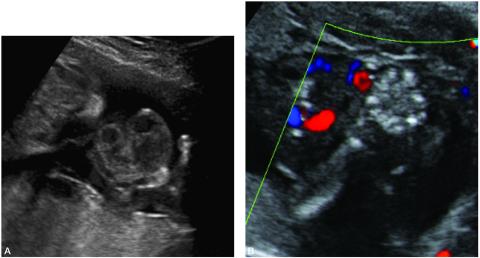 Amniotic Band Syndrome, Fetal Care and Treatment Center